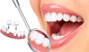 Làm răng thẩm mỹ: giải pháp cho bạn quan tâm thẩm mỹ răng