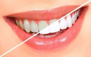 Phục hình răng sứ thẩm mỹ: Giải pháp lấy lại nụ cười tự tin